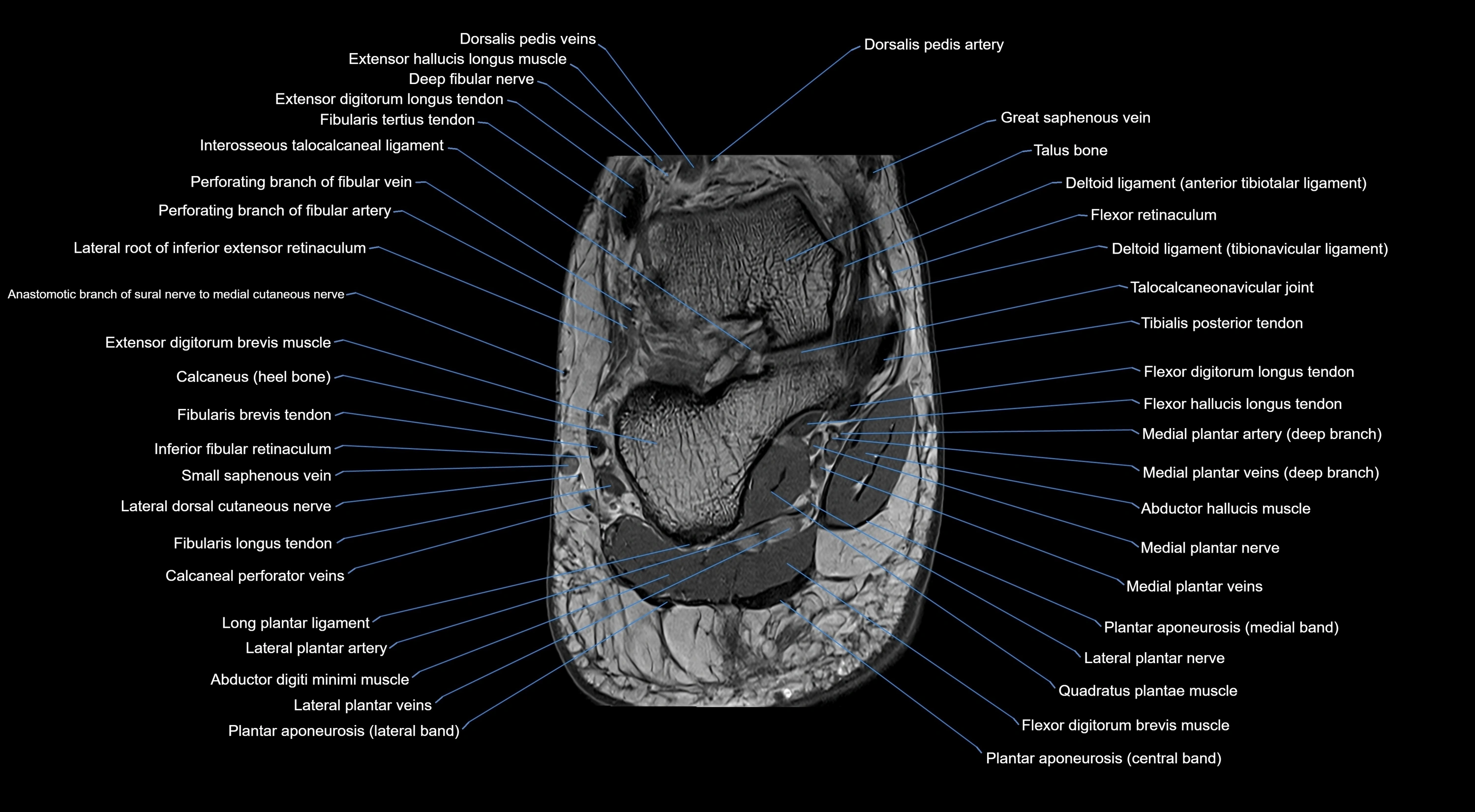 MRI mid foot coronal ligaments cross sectional anatomy 3T  radiology  image-img-00001-00044.webp